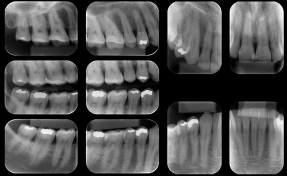 Radiografia Periapical(dIGITAL) Em